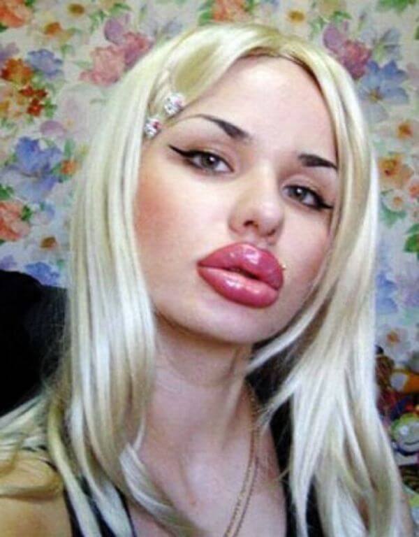 Plastic Surgery Gone Wrong Pictures That Will Make You Feel