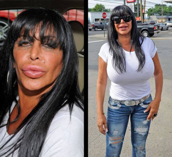 31 Plastic Surgery Gone Wrong Pictures That Will Make You Feel 9087