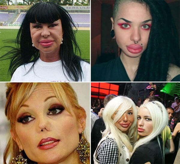 plastic surgery bad results 16