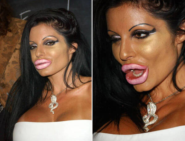 plastic surgery bad results 17