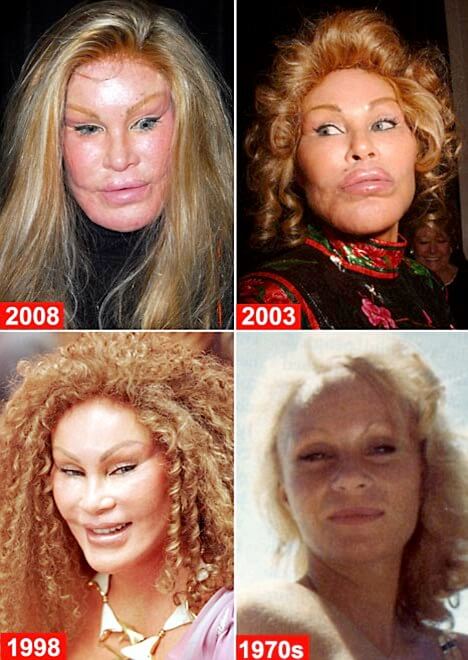 plastic surgery gone wrong (1)