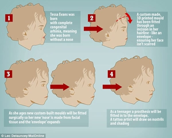 baby born with no nose 9