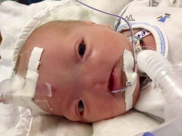 baby born with no nose 2