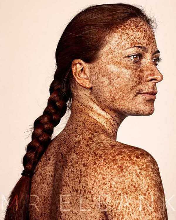 Freckles are Beautiful 5
