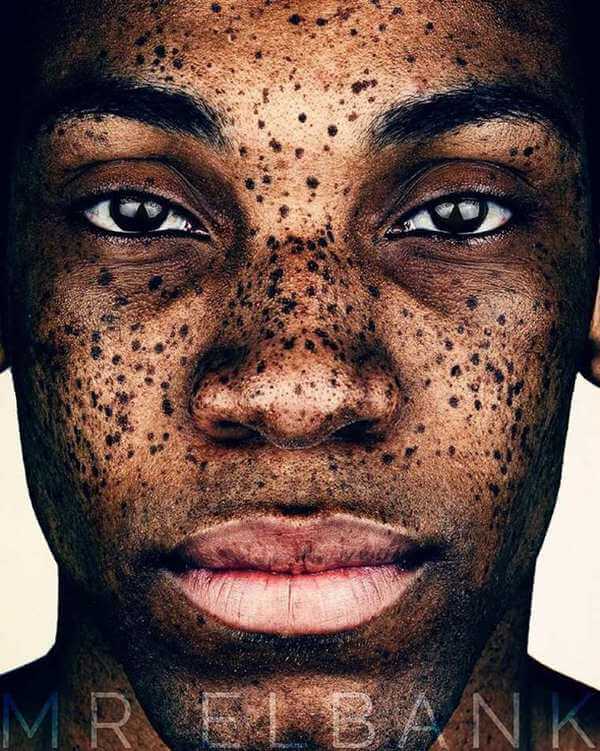 Freckles are Beautiful 6