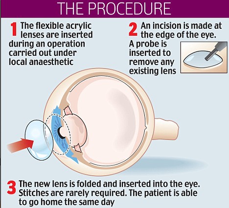 bionic lens implant