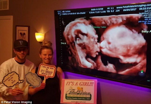 identical twins kissing ultrasound (4)