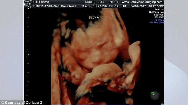identical twins kissing ultrasound (5)