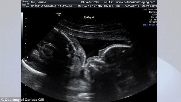 identical twins kissing ultrasound (6)