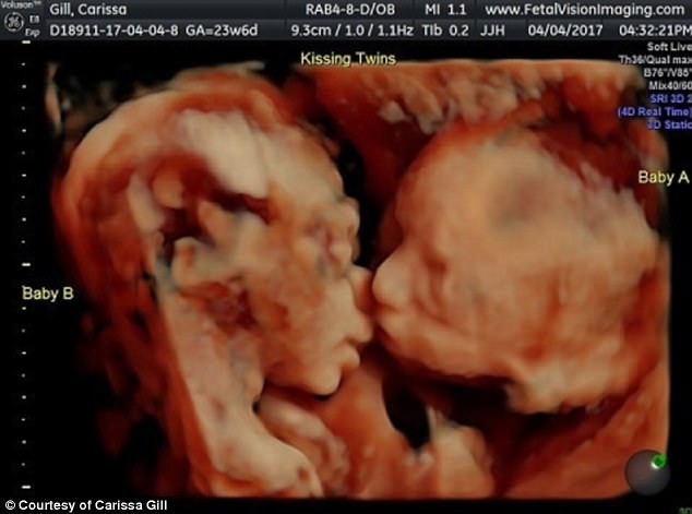 Adorable Moment When An Ultrasound Photo Shows Twin Baby ...