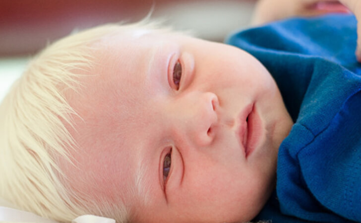 baby born with white hair 9 (1)